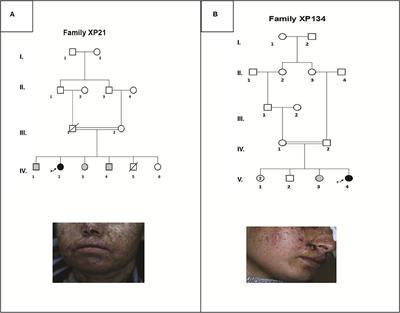 Case Report: Identification of Novel Variants in ERCC4 and DDB2 Genes in Two Tunisian Patients With Atypical <mark class="highlighted">Xeroderma</mark> Pigmentosum Phenotype